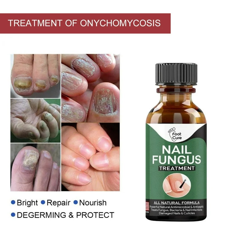Foot Cure Nail Fungus Solution