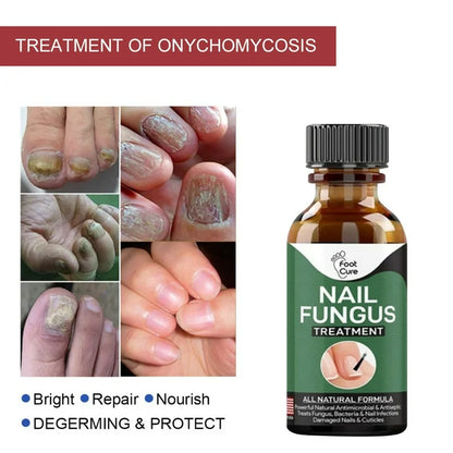 Foot Cure Nail Fungus Solution